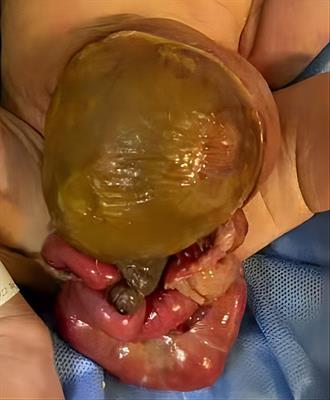 Ruptured giant omphalocele with congenital short small intestine: a case report